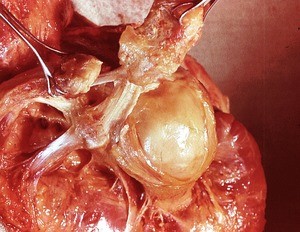 Natural color photograph of dissection of the left shoulder, superoanterior view, with the muscle layers reflected and the acromion and clavicle reflected from each other at the acromioclavicular joint