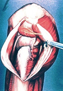 Illustration of surgically exposed lateral aspect of hip joint capsule (gluteus maximus muscle divided and retracted, gluteus medius and minimus muscles cut away from the greater trochanter and reflected upward) piriformis muscle cut away from its insertion