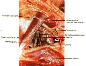 Natural color photograph of left side of neck, lateral view, showing nerves, muscles, bone and vein