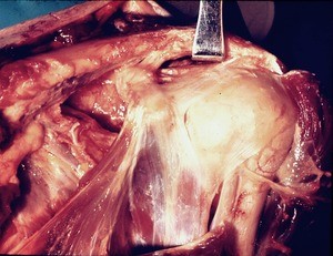 Natural color photograph of dissection of the left shoulder, anterior view, showing the relationship between bones and muscles of the shoulder