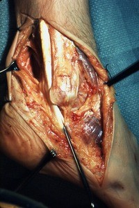 Natural color photograph of dissection of the right ankle, lateral view, emphasing fibularis longus t. and the fibularis brevis t