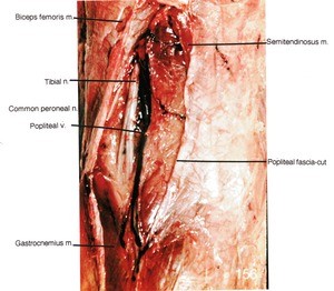 Natural color photograph of dissection of the left popliteal fossa, posterior view, showing the tibial nerve