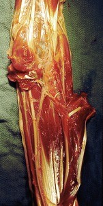 Natural color photograph of dissection of the left forearm, anterior view, with the flexor digitorum superficialis muscle cut and reflected to expose the flexor digitorum profundus tendon