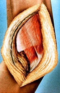 Illustration of surgical exposure of pronator teres muscle and flexor carpi radialis muscle just anterior to cubital fossa