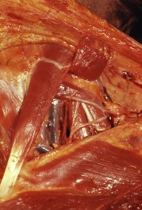 Natural color photograph of dissection of the neck, right anterior view, showing the internal jugular vein, with the clavicular head of the sternocleidomastoid m. cut and reflected