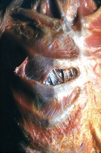 Natural color photograph of dissection of the left thorax, anterior view, with the superficial musculature removed to expose the underlying bone and muscle structure