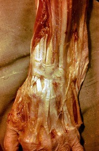 Natural color photograph of dissection of the left wrist, posterior view, with the skin removed to expose the extensor retinaculum and tendons of the forearm extensor muscles