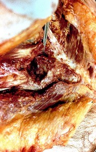 Natural color photograph of dissection of the neck, anterolateral view, with the right sternocleidomastoid m. cut and reflected