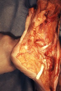 Natural color photograph of dissection of the right ankle, lateral view