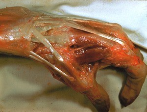 Natural color photograph of dissection of the left hand, lateral view, showing tendons and musculature