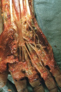 Natural color photograph of dissection of the right hand, anterior view, with the transverse carpal ligament cut to expose the median nerve