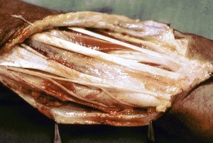 Natural color photograph of dissection of the forearm, showing tendons