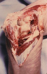 Natural color photograph of dissection of the elbow, posterior view