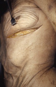 Natural color photograph of dissection of the thorax, anterolateral view, showing surface anatomy