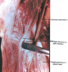 Natural color photograph of left knee, lateral view, showing muscles, and nerve