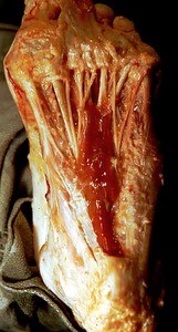 Natural color photograph of dissection of the plantar surface of the left foot