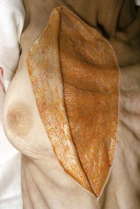 Natural color photograph of dissection of the right upper thorax (female), anterior view, with skin reflected to reveal the pectoral fascia