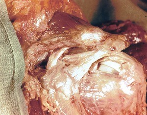 Natural color photograph of dissection of the left shoulder, anterolateral view, with the deltoid muscle reflected to expose the attachments of the short head of the biceps brachii, coracobrachialis, and pectoralis minor muscles to the coracoid process