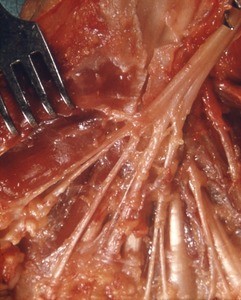 Natural color photograph of dissection of the hand, anterior view, showing the branches of the median nerve