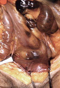 Natural color photograph of dissection of the pelvic and lower abdominal cavity, anterior view, with the small intestine reflected to expose the underlying abdominal viscera and mesentery