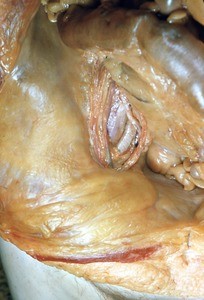 Natural color photograph of dissection of the lower abdomen and pelvic cavity, anterior view, with an incision in the peritoneum to expose retroperitoneal nerves and vessels