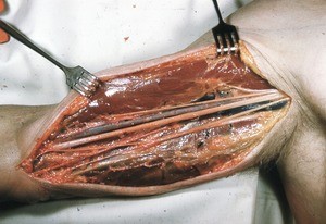 Natural color photograph of dissection of the right arm arm, showing muscles and neurovasculature