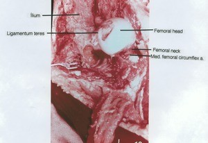 Natural color photograph of dissection of hip joint with the femoral head dislocated