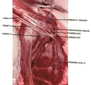 Natural color photograph of dissection of the brachial plexus, showing the cords and divisions