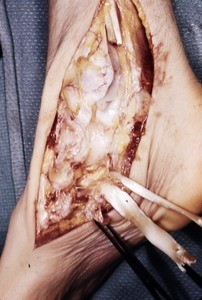 Natural color photograph of dissection of the right ankle, medial view, with the tibialis posterior t. and the flexor digitorum longus t. cut and reflected