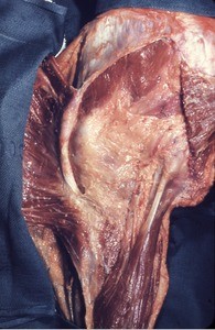 Natural color photograph of dissection of the left gluteal region, with the gluteus maximus muscle cut and reflected laterally