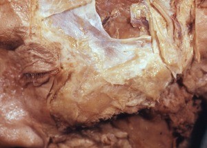 Natural color photograph of dissection of the face, anterolateral view, with the skin surrounding the bridge of the nose removed to expose the underlying fascial layers