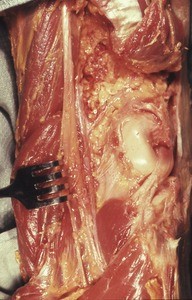 Natural color photograph of dissection of the popliteal fossa, showing popliteal vessels and tibial nerve