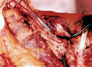 Natural color photograph of dissection of the thoracic wall, anterior view, with the right sternocleidomastoid muscle cut away from the sternum