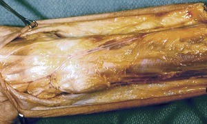 Natural color photograph of dissection of the forearm, posterior view, showing vasculature