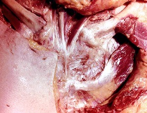 Natural color photograph of dissection of the thoracic wall, overlying the sternum