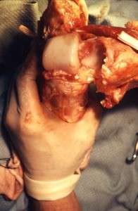 Natural color photograph of dissection of the ankle, disarticulated, showing the articular surfaces of the tibia, fibula and the talus