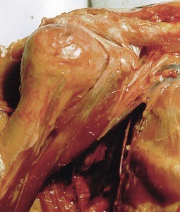 Natural color photograph of dissection of the right shoulder, anterior view, showing muscle and bone structure