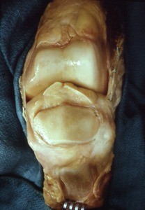 Natural color photograph of dissection of the left knee, anterior view, with the patella reflected inferiorly