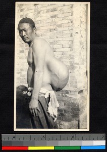 Chinese man with a large back tumor, Nantong, Jiangsu, China, ca.1900-1932