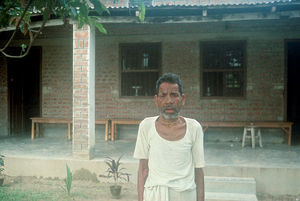 Diasserie, Bangladesh 1990: "Spedalskhed - den gamle svøbe" - Nr. 04: Spedalsk mand med næse-kollaps. Et andet symptom af særlig ulykkelig karakter, som også kun optræder hos patienter med lav eller ingen modstandskraft, er ødelæggelse af næsens bærende strukturer, med sammenfald til følge. Dette giver en stor kosmetisk gene, også fordi alle genkender det som et spedalskhedstegn, så symptomet kan få stor betydning for patientens sociale forhold