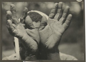 Yaws, Tanzania, ca.1929-1940