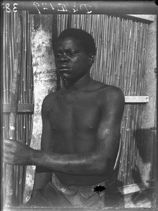 African patient, Matutwini, Mozambique, ca. 1930