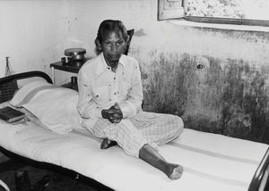 Mohulpahari, Santal Parganas, Nordindien. En spedalsk patient, Saldoha Spedalskhedskoloni, april 1988