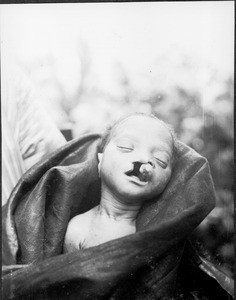 A deformed baby, Tanzania, ca. 1927-1938