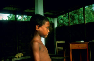 Diasserie, Bangladesh 1990: "Spedalskhed - den gamle svøbe" - Nr. 14: En spedalsk dreng. For at behandlingen skal lykkes godt, er det vigtigt at patienter bliver fundet, før der optræder skader. På langt sigt skulle spedalskhedsarbejdet gerne føre til, at patienter kommer i behandling, når de første pletter viser sig. Det er sket med denne dreng, som bedstemor har bragt til behandling på klinikken. Ofte kan det ved få tegn være svært at afgøre, om det er spedalskhed, da symptomerne kan minde om mange hudsygdomme. Og på grund af de sociale konsekvenser er det meget vigtigt ikke at få kaldt nogle spedalske, som ikke er det. En vigtig ting, når man får en ny patient, er at undersøge patientens omgivelser for spedalskhed, og at gentage det med jævne mellemrum, da der kan gå fra måneder til år, fra man bliver smittet, til sygdommen bryder ud