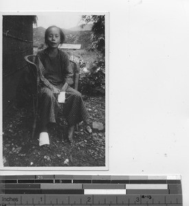 A young lady with leprosy at Jiangmen, China, 1934