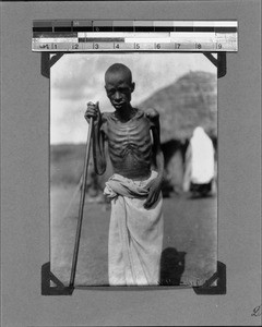 African man suffering from hookworm, Nyasa, Tanzania, 1929