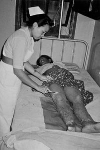 UMN, Nepal. A local staff nurse treating a patient with burned legs, United Mission Hospital Ta