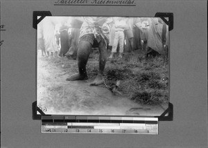 Clinical picture of a partial gigantism of the right leg, Nyasa, Tanzania, 1929