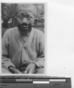 A boy with advanced leprosy at Jiangmen, China